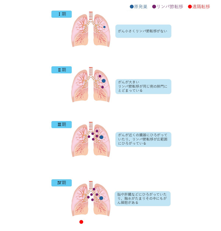 肺がんの臨床病期（ステージ）