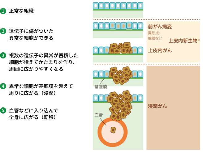 ①正常な組織 ②遺伝子に傷がついた異常な細胞ができる ③複数の遺伝子の異常が蓄積した細胞が増えてかたまりを作り、周囲に広がりやすくなる ④異常な細胞が基底膜を越えて周りに広がる (浸潤) ⑤血管などに入り込んで全身に広がる (転移)