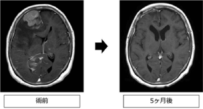 術前と5ヶ月後の比較