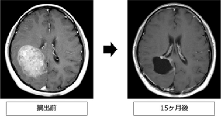 摘出前と15ヶ月後の比較