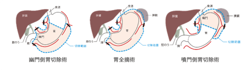 幽門側胃切除術 胃全摘術 噴門側胃切除術