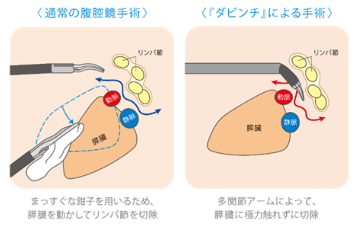 通常の腹腔鏡手術:まっすぐな鉗子を用いるため膵臓を動かしてリンパ節を切除、ダビンチによる手術:多関節アームによって膵臓に極力触れずに切除