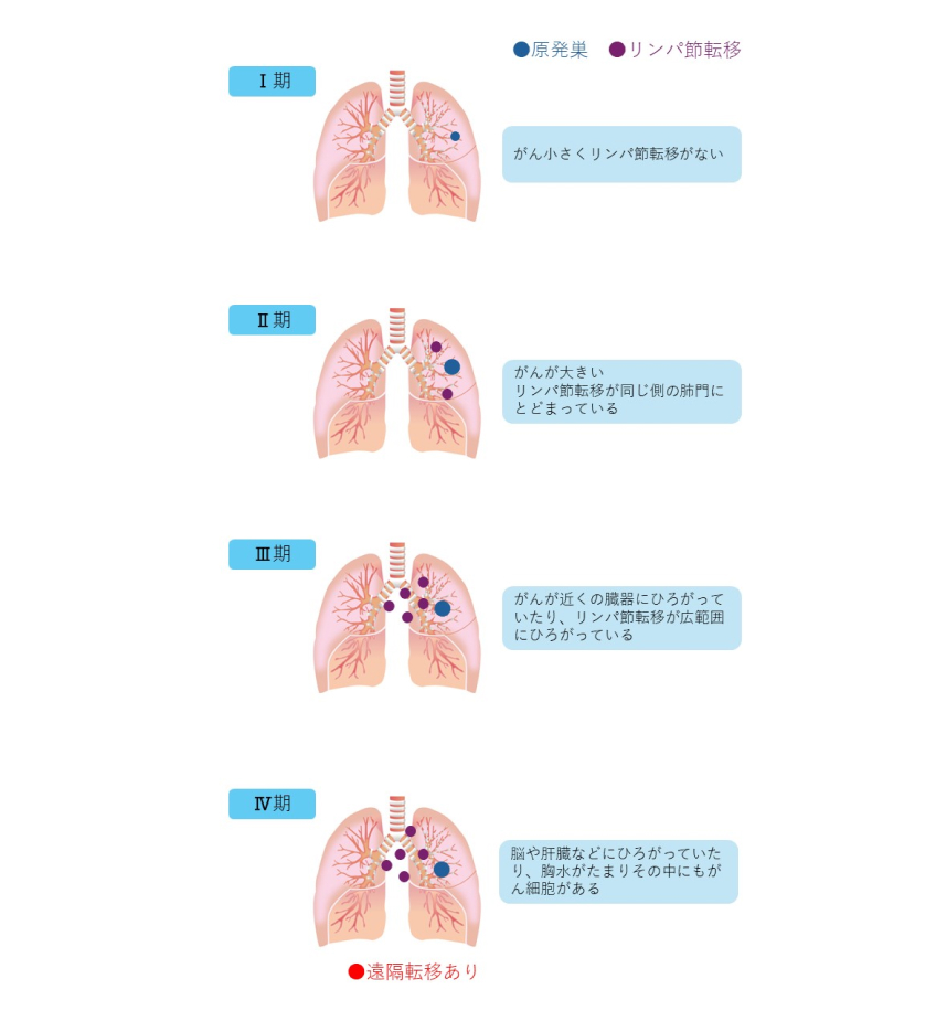 肺がんの臨床病期（ステージ）