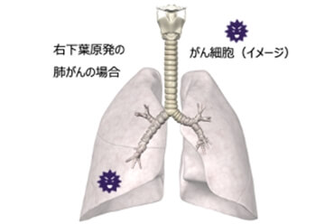 右下葉原発の肺がんの場合