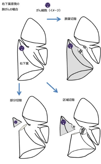 右下葉原発の肺がんの場合
